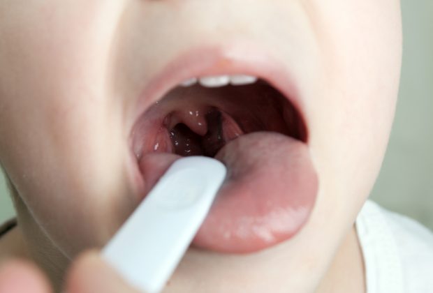 tonsillite-nei-bambini-cause-sintomi-rimedi