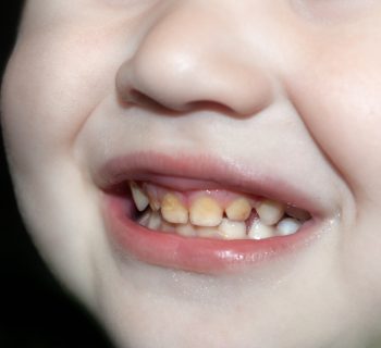 denti-macchiati-bambini-ipomineralizzazione