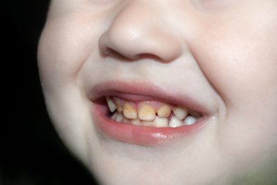 denti-macchiati-bambini-ipomineralizzazione