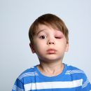 immunoterapia-specifica-contro-allergie-bambino