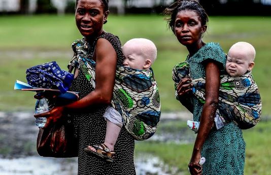 il-massacro-dei-bambini-albini-africani-uccisi-per-il-commercio-di-organi