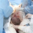 spina-bifida-corretta-in-utero-il-bambino-nasce-sano